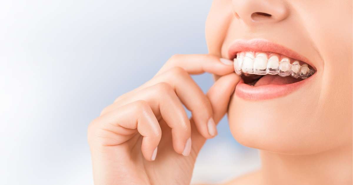 Benefits of Invisalign